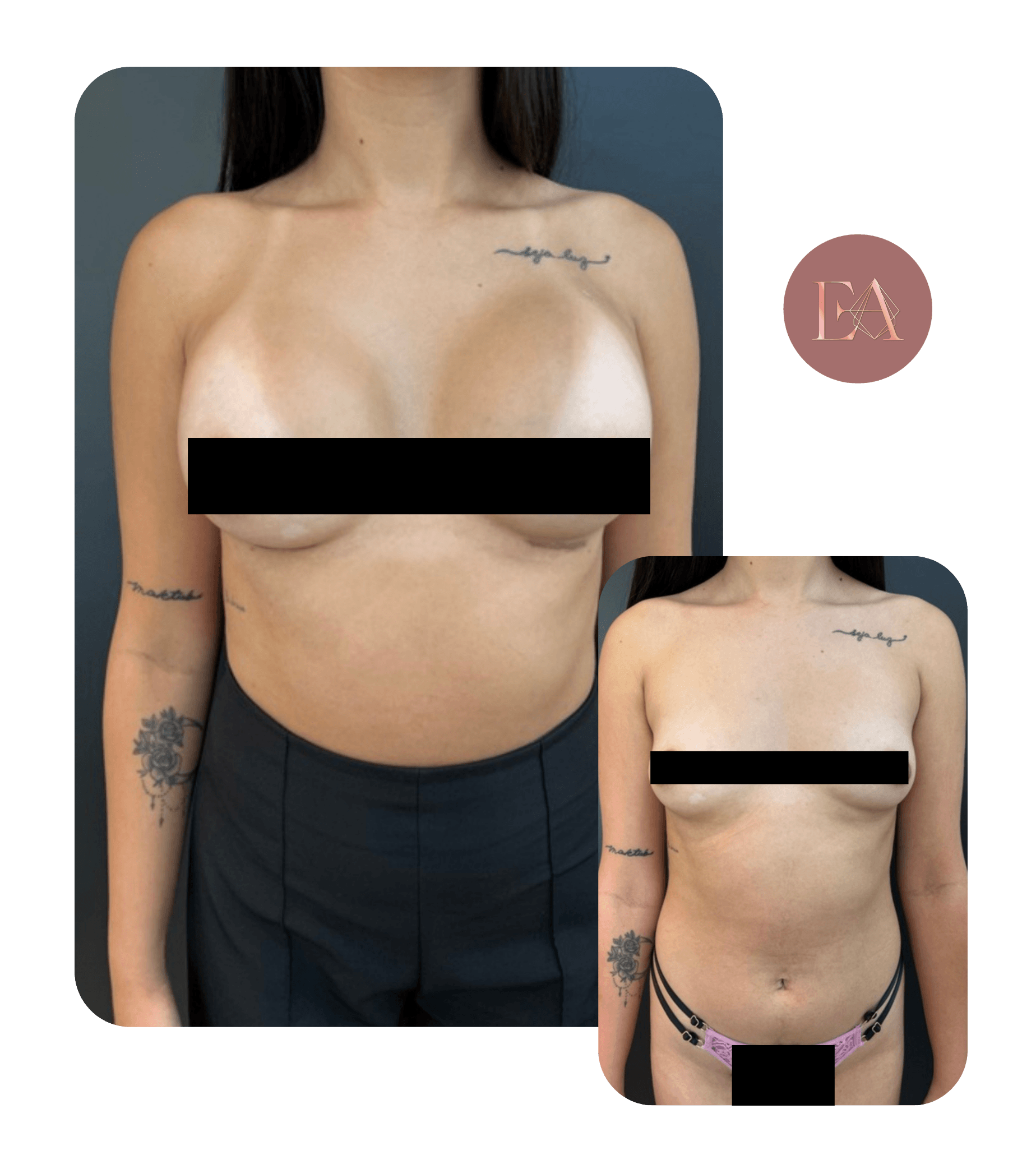 Antes e depois de paciente da Dra. Emelyn